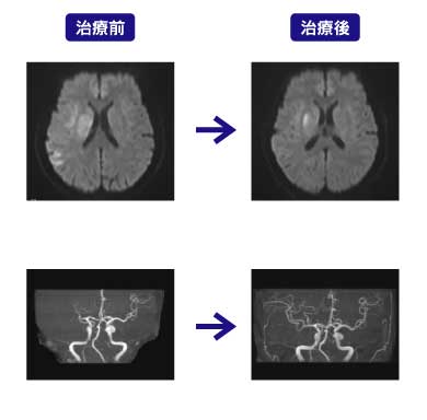 治療前後の脳の状態を比較
